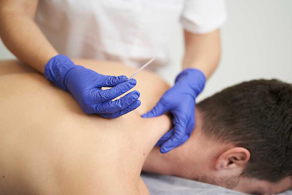 Dry Needling-penticton pain clinic